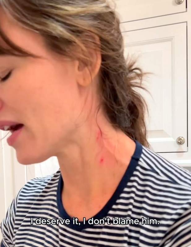 Jennifer Garner cat scratches